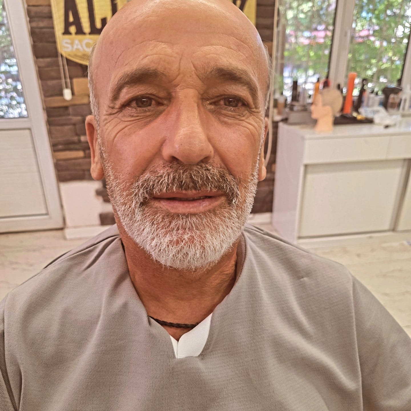 Before hair system – male hair loss case with advanced alopecia, treated at Eterna Face Bristol