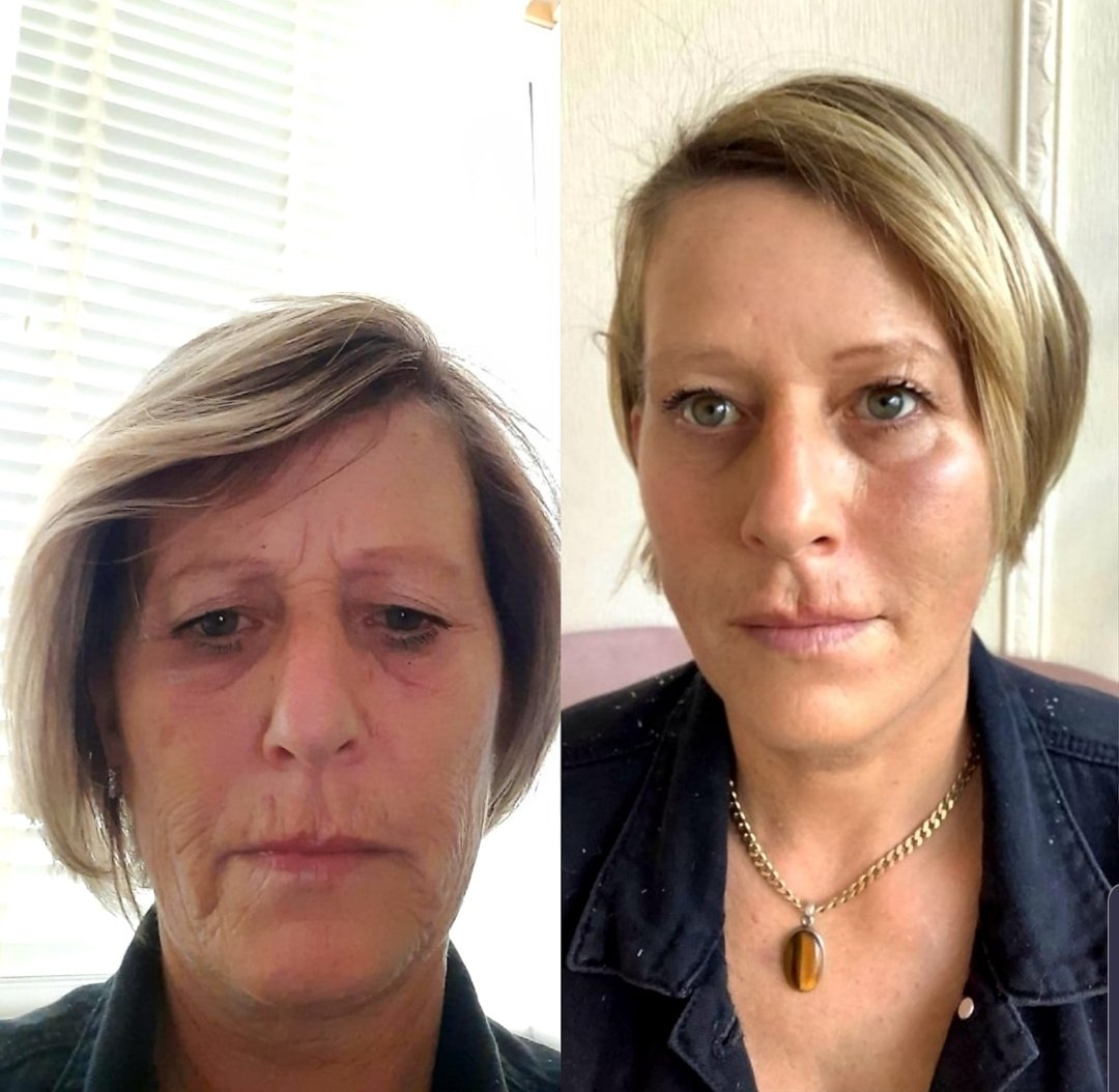 Full Face Rejuvenation