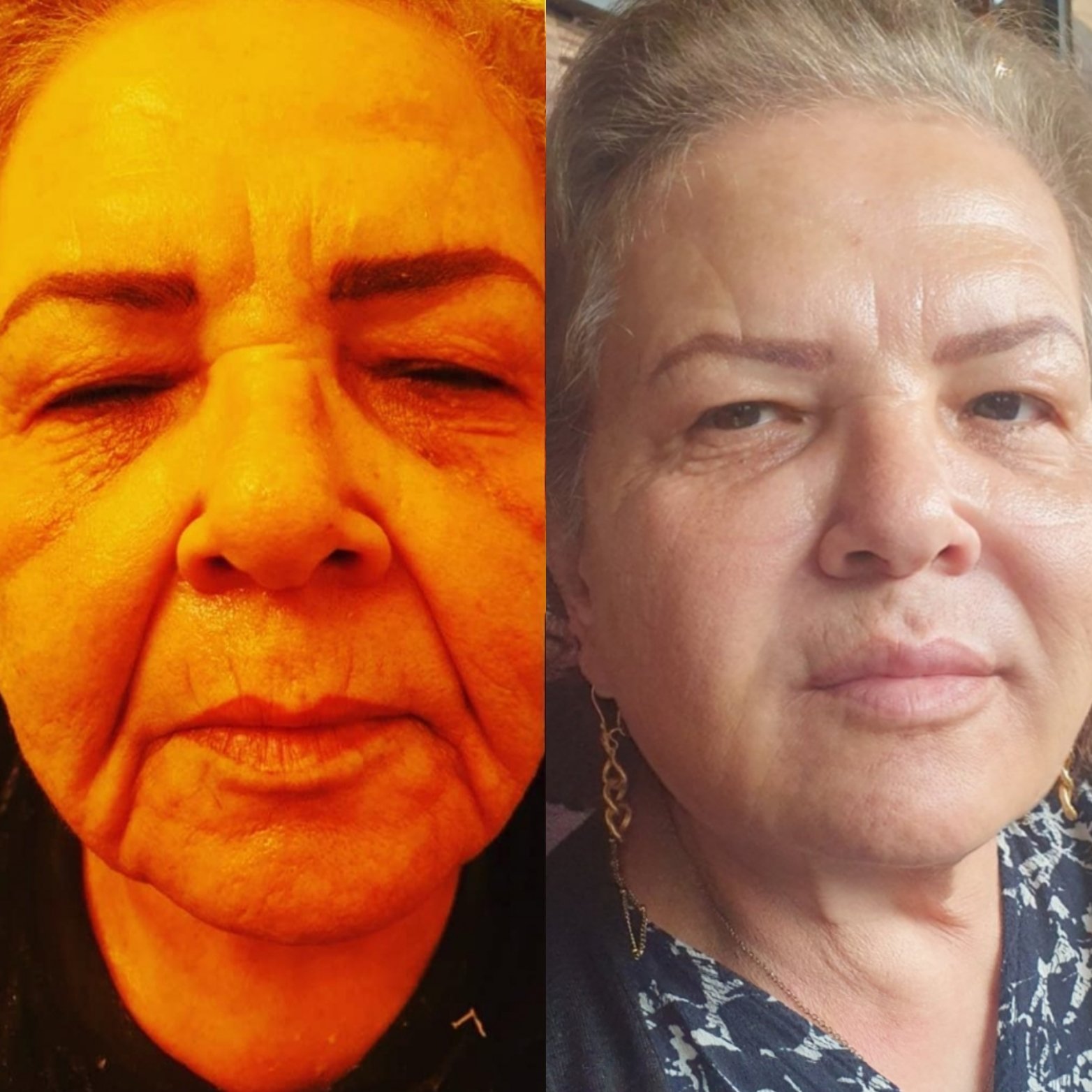 Full Face Rejuvenation