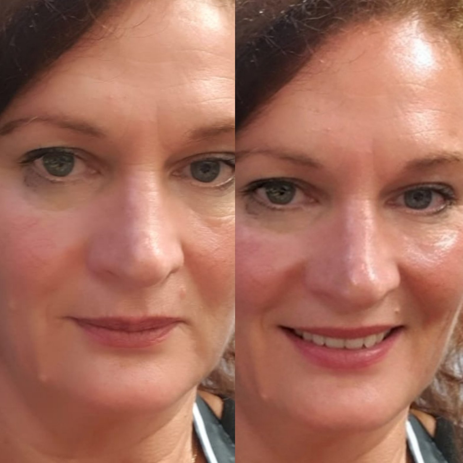 Collagen Skin Booster